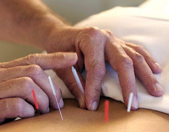 acupuntura