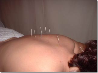 acupuntura