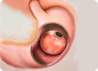 balon-intragastrico