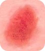 El color de los moratones o hematomas