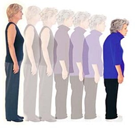 osteoporosis