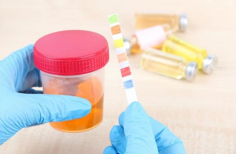 El color de la orina y su significado médico: cuándo es un síntoma de